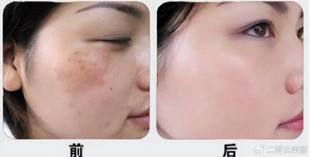 超皮秒恢复期多久超皮秒反黑后多久才能恢复正常服了