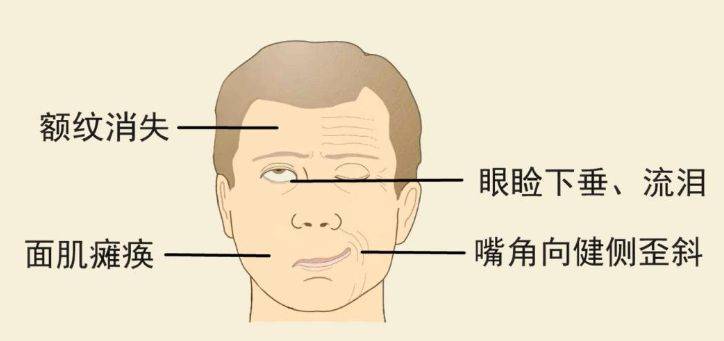 面瘫是以口眼向一侧歪斜为主要表现的疾病,又称为口眼歪斜