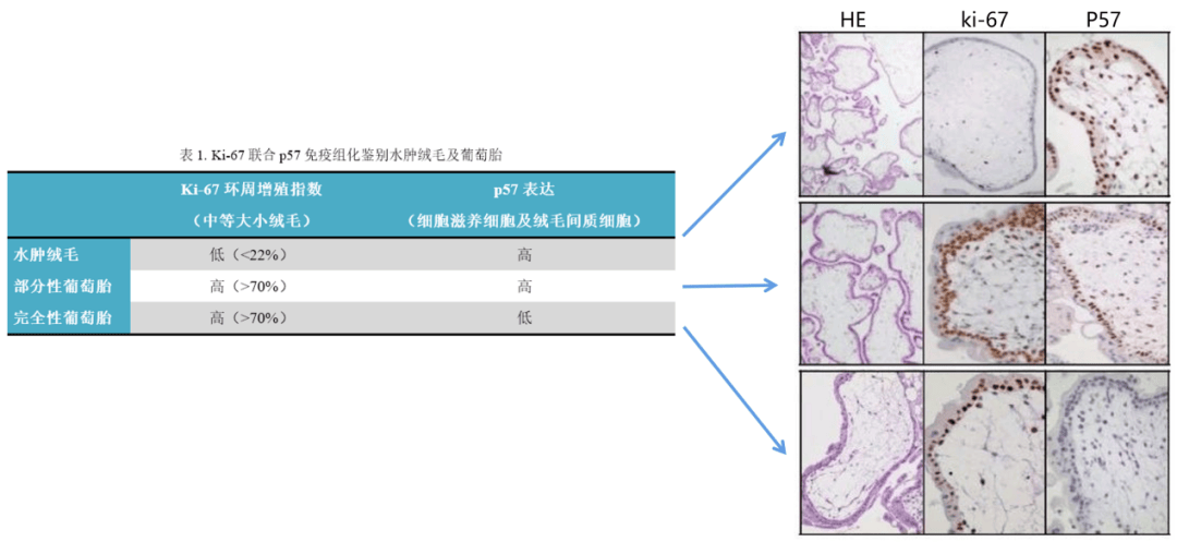 葡萄胎b超图片图片