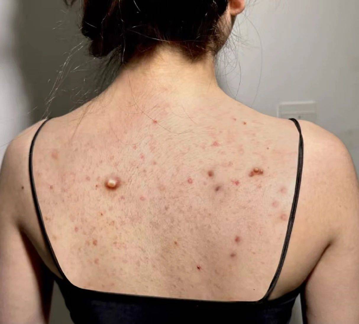 重度后背痘已断根28天痘痘油脂去无踪动动手就能操作