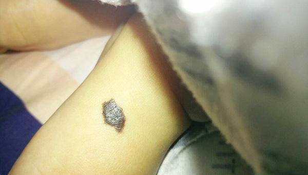 原创点痣安全吗哪些部位的痣不能点或许很少有人知道正确答案