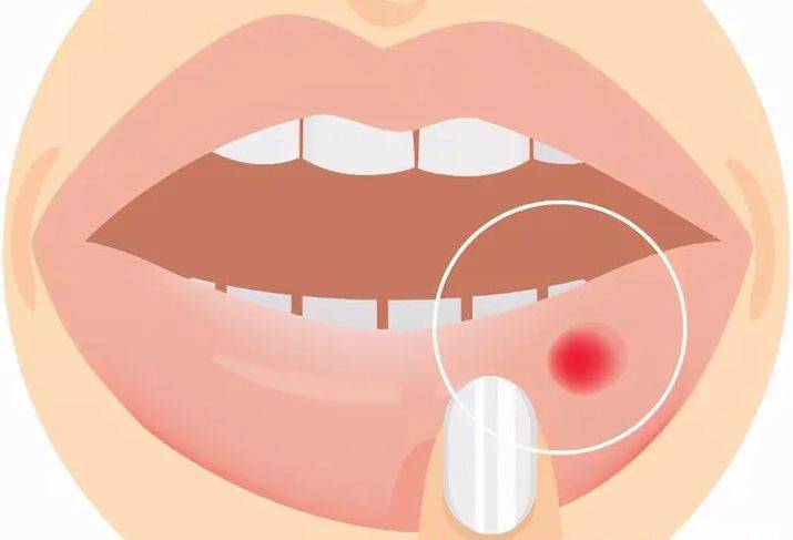 溃疡是一种常见的发生于口腔黏膜的溃疡性损伤病症,多见于唇内侧,舌头