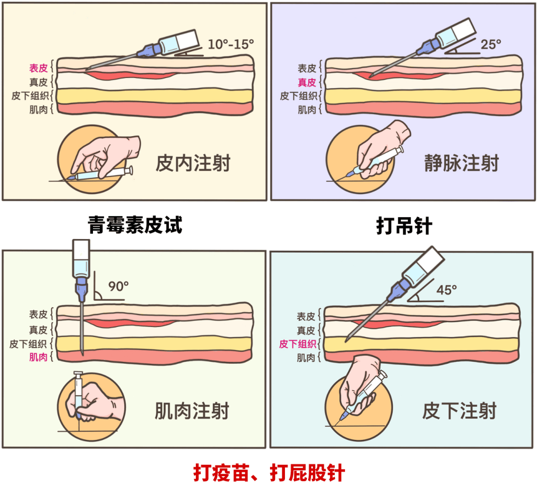 图解皮试,皮下注射,静脉注射和肌肉注射