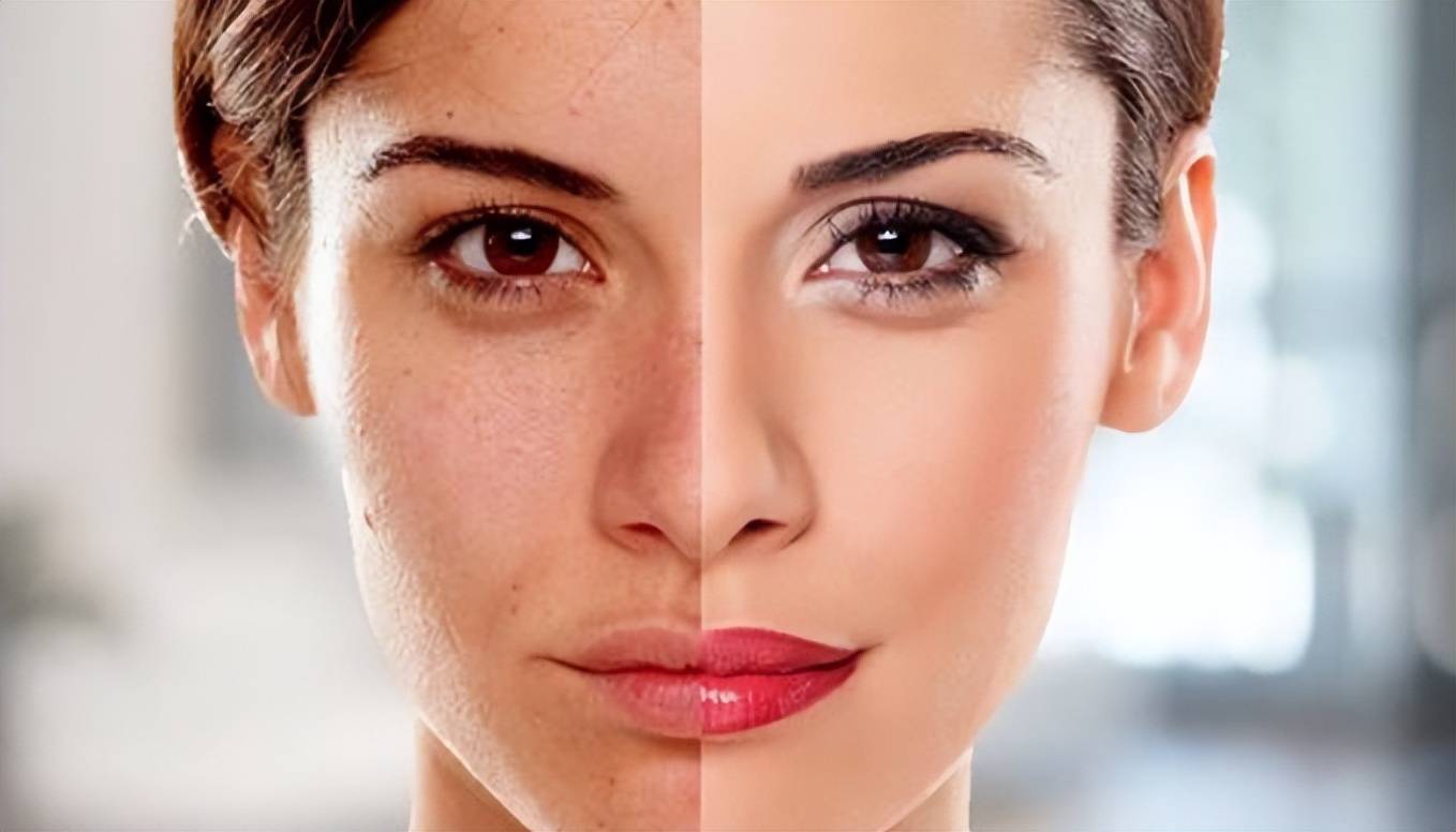 超皮秒祛斑10天变化图片吐血分享超皮秒祛斑真实效果