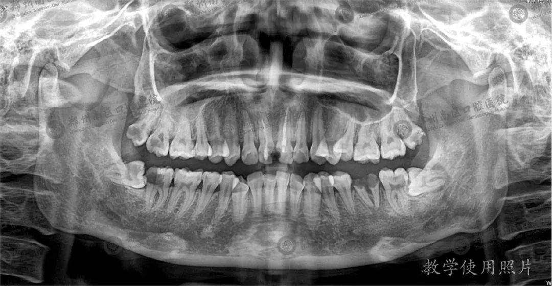通过全景片可以观察到口腔内所有牙齿的情况以及颌骨内的情况