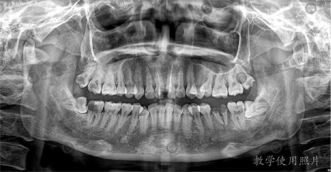 大牙牙根图片x光图图片