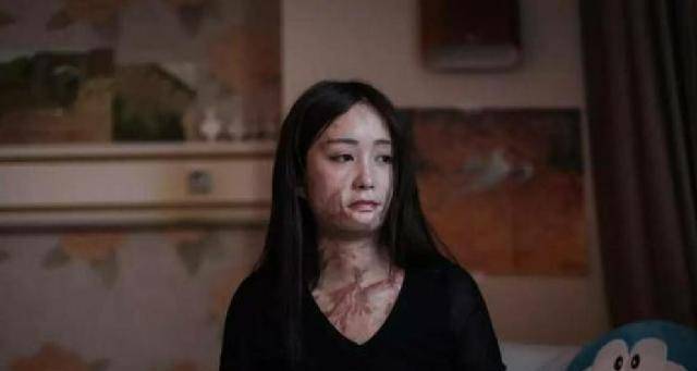 原创安徽16岁少女周岩因拒绝官二代被泼汽油毁容如今过得还好吗