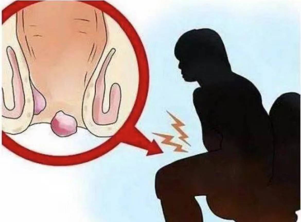 痔疮患者注意了过来人分享无需手术的除痔法已有多人用此法治愈