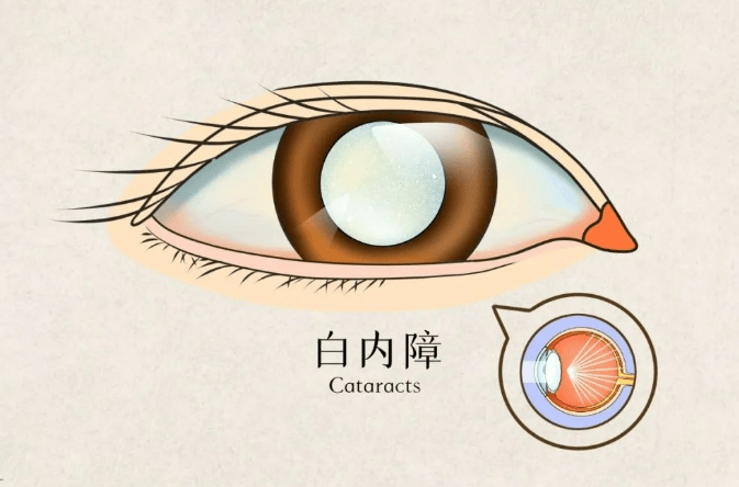 蛋白质变性发生混浊的眼部疾病,白内障患者常伴有视物模糊,重影,眩光