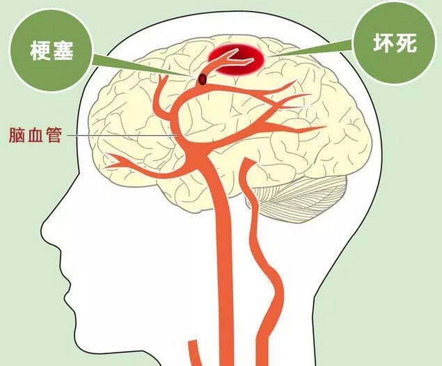 脑梗塞部位及症状图片图片