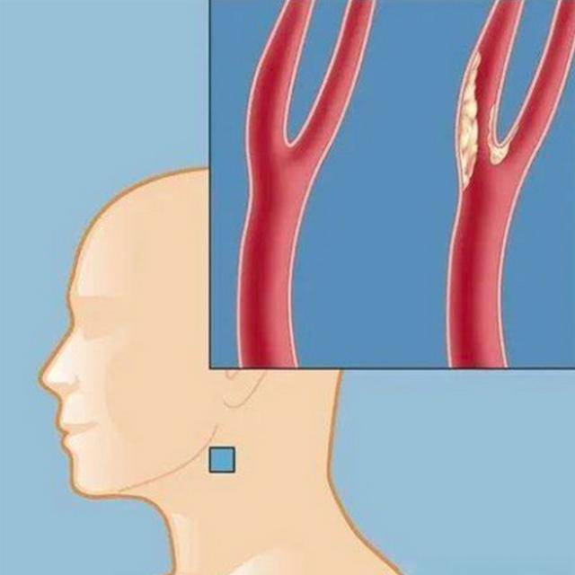 颈动脉出现了斑块,对身体哪个部位影响最大?需注意什么呢?