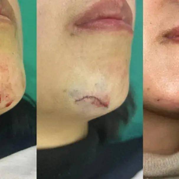 美容缝合 疤痕预防,让每一个伤口被温柔以待!