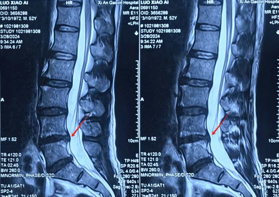腰椎间盘突出症影像图片
