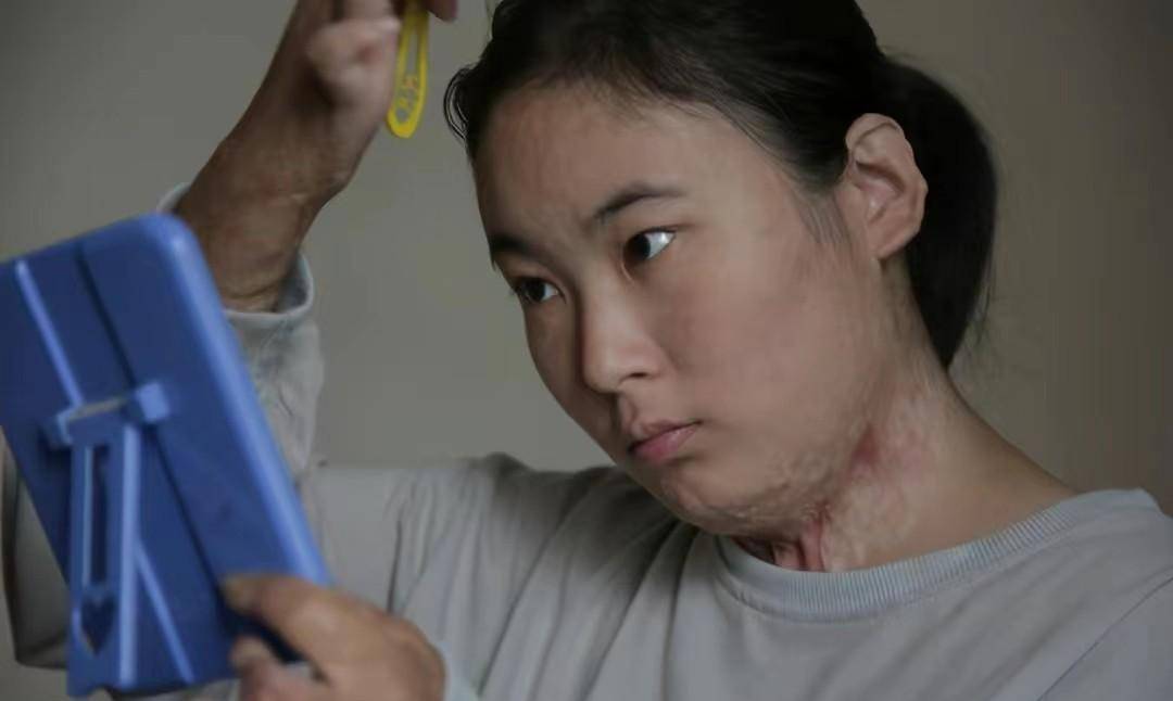 18年河南大火,16岁姐姐全身90%烧伤毁容,弟弟的举动让人泪目