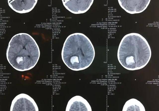 头部外伤通过ct扫描,可以清晰地观察到骨骼和关节的结构和形态变化,为