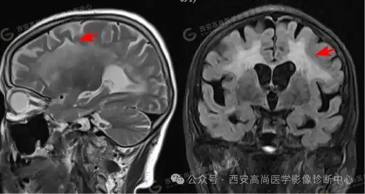 脑包虫核磁图片图片