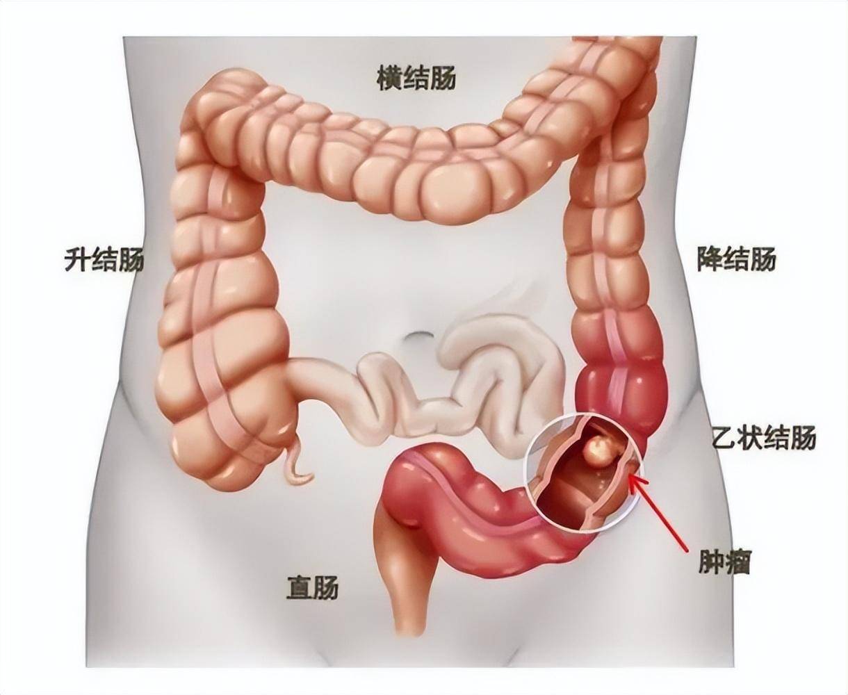 结直肠癌示意图健康管理中心下设健康教育随访部,负责体检人群的异常