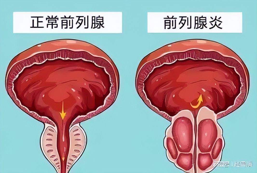 女性前列腺肥大图片