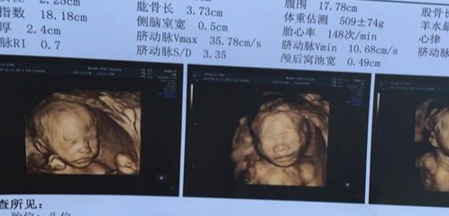 孕妇四维彩超要不要做?对宝宝好吗?5点注意事项孕妈要知道