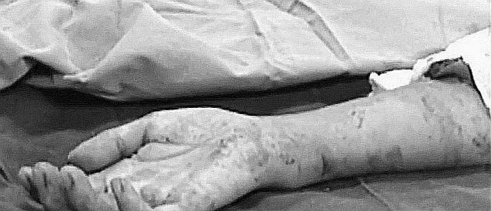 2006年,长沙男子断臂被移植在大腿上,手术后大喊:让我死掉算了