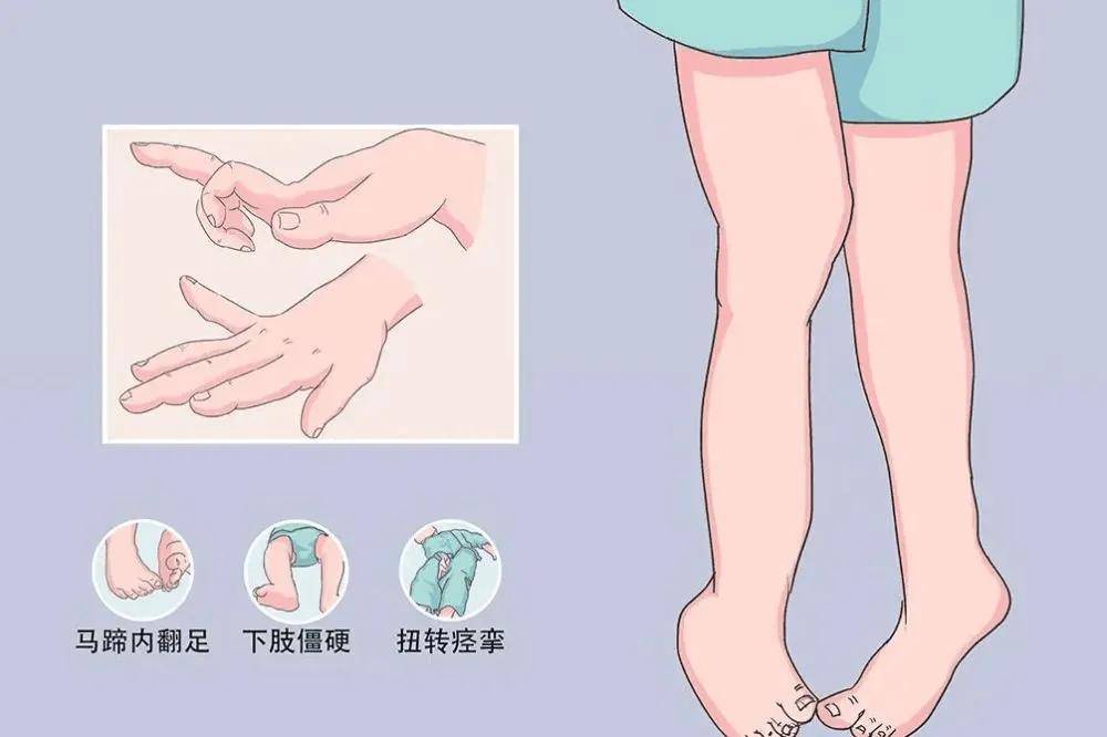 有的症状类似帕金森但并非帕金森