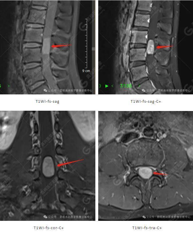 14岁男孩,腰腿痛,下肢麻木不可忽视椎管内神经鞘瘤