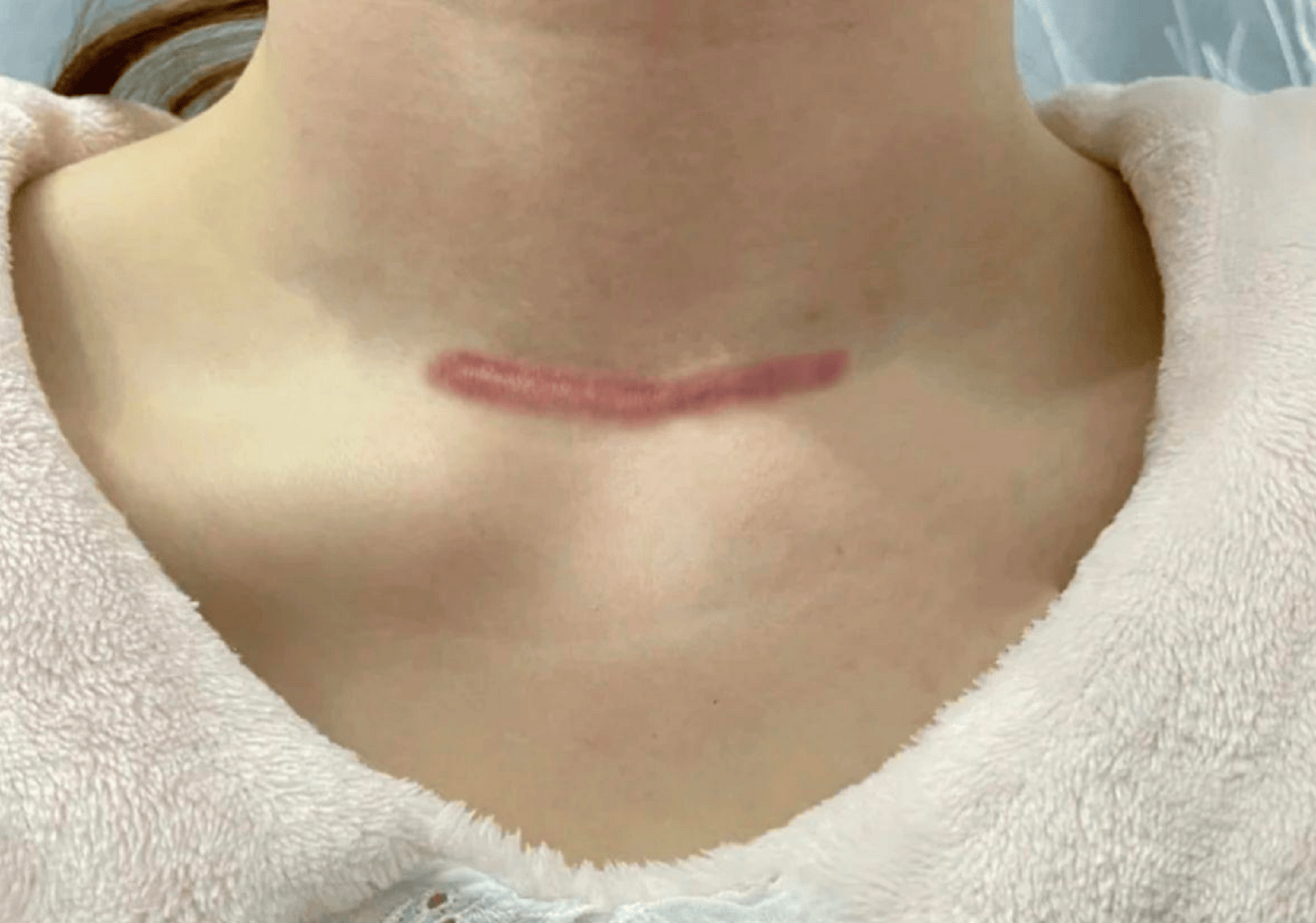 术后疤痕亲身试验!效果不同的祛疤产品!祛疤每一个都超有用!