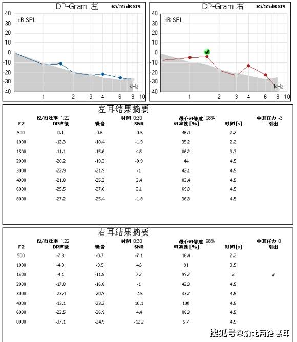 241000hz鼓室曲线 226hz鼓室曲线 鼓室压力dapa 声顺值ml声导抗60