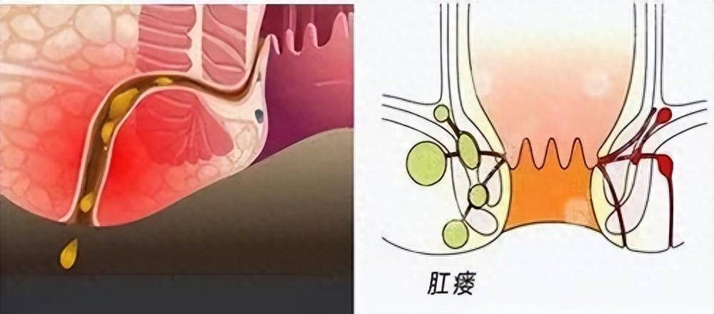 直肠阴瘘症状图片图片