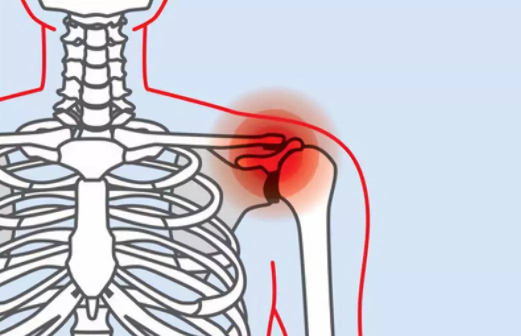 肩周炎哪里痛图片解析图片