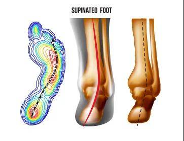 小扁平足:足横弓塌陷的别称及其原因