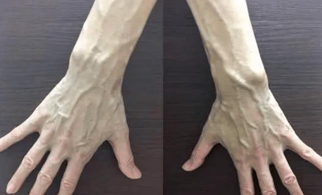 有人手臂"青筋凸起",有的人几乎看不到青筋,谁的更健康呢?