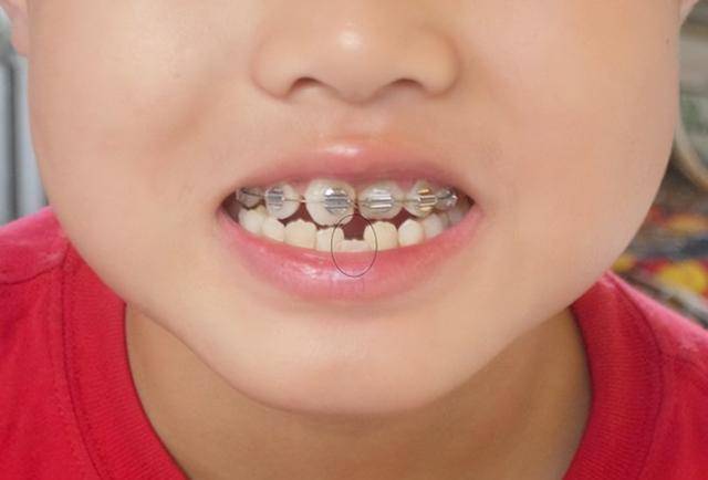 儿童牙齿矫正乱象:两岁半幼童每天戴12小时牙套!