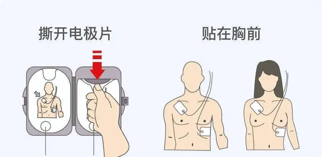 除颤仪三导联位置图片图片