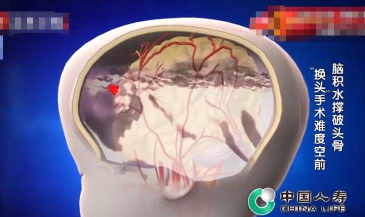 脑积液,为了不产生过大的压力,需要一点点地放出来,第一袋积水被排除