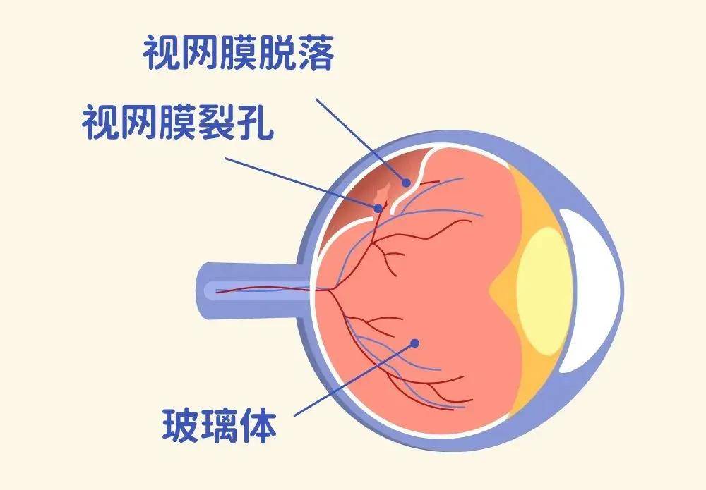 近视眼底照片图片