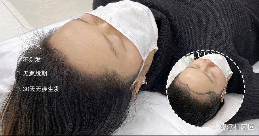 创新头皮管理,实现科技生发——绒毛发际线_毛囊_技术_问题