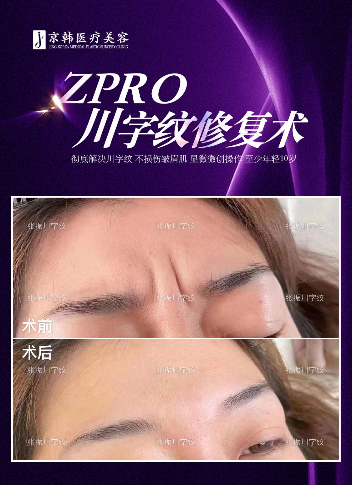 去除川字纹是打玻尿酸还是除皱针好