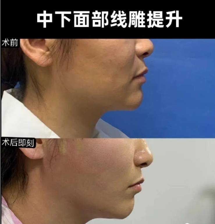 面部提升做线雕能维持多久_线雕面部提升_线雕面部提升术过程大揭秘