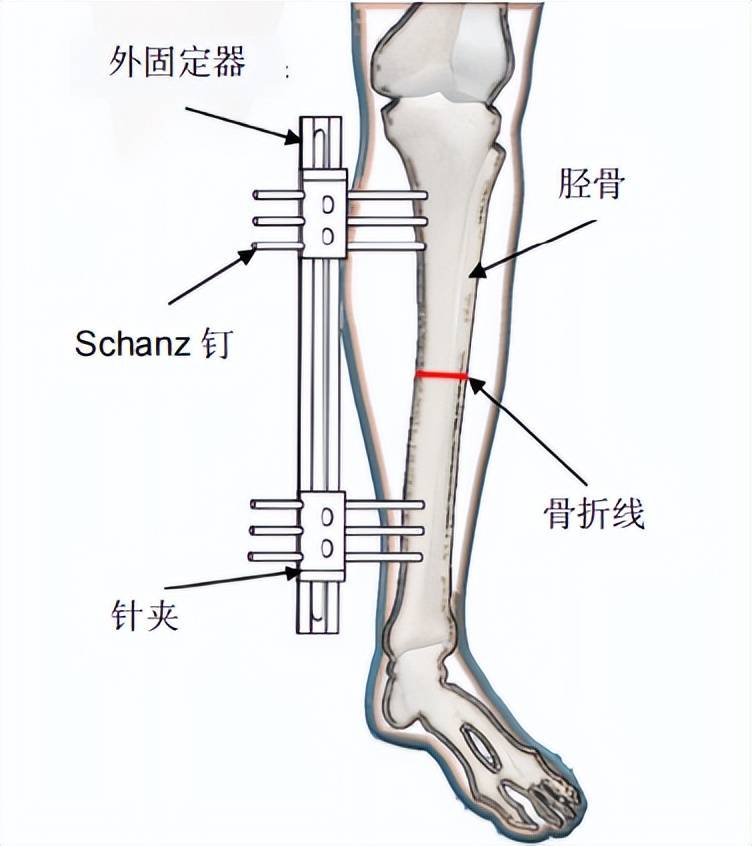 科马洛夫腿骨图片