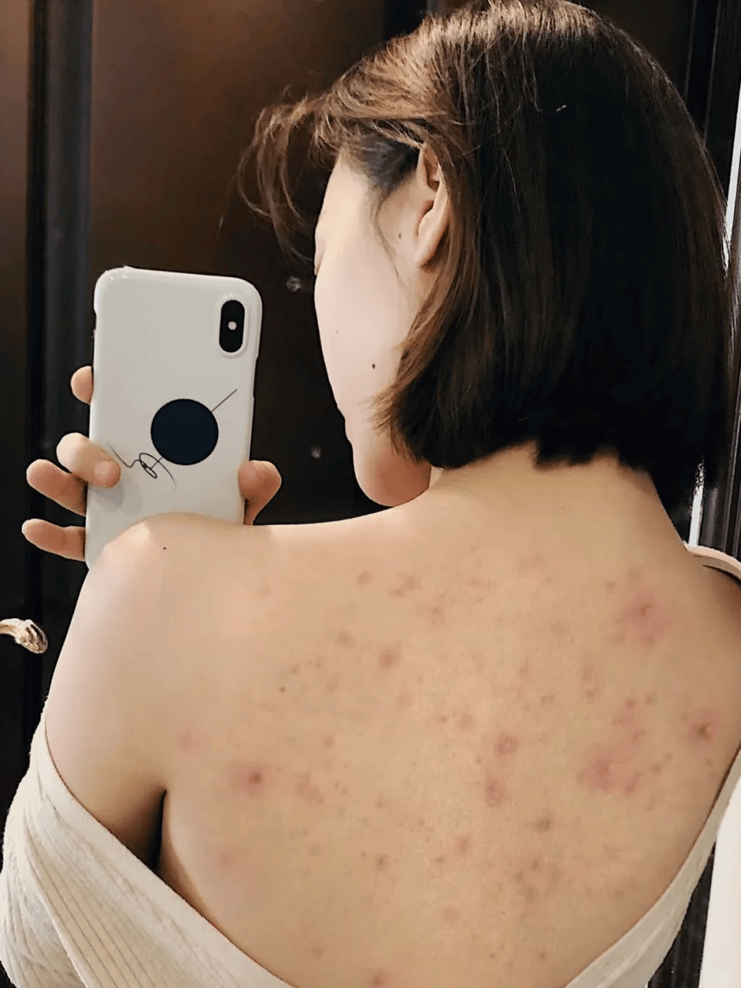 痘肌必看!在家除螨祛痘不留痕!一个月背痘全消重拾牛奶肌!