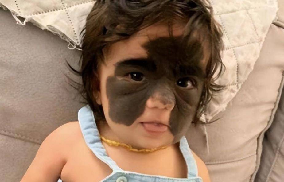 还记得天生胎记酷似"蝙蝠侠"的女婴吗?6次整容后,仍需治疗