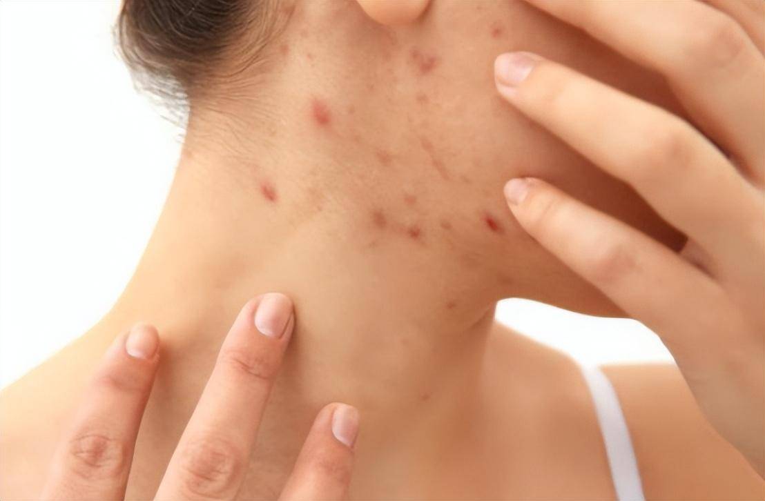 身上出现这种红点,警惕癌症风险!