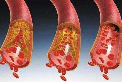 3个信号暗示血液粘稠,7样食物"稀释"血液,身体更健康_血管_胆固醇