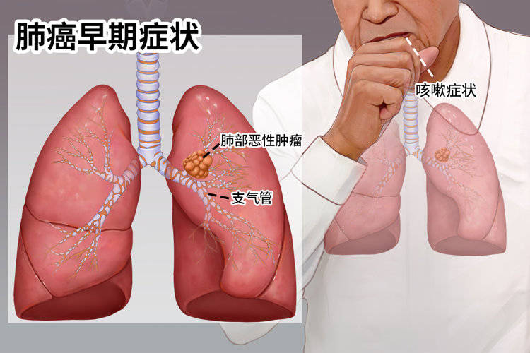 咳嗽时若伴随5种现象,或是肺癌信号