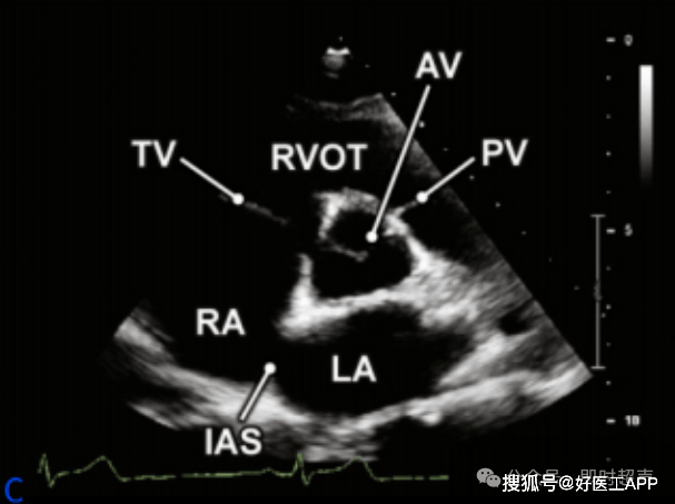 床旁超声心动图的基本测量