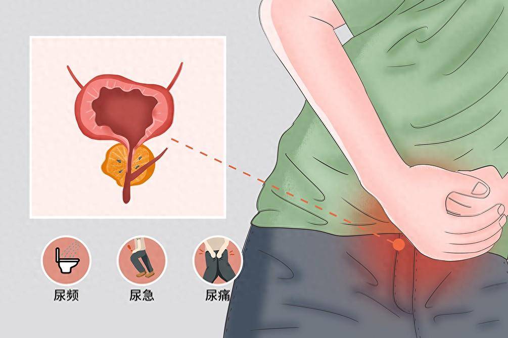 男性膀胱炎有什么症状图片