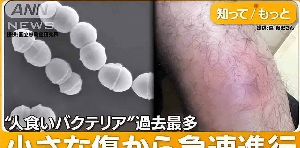 日本食人菌感染人数超千，到底什么是食人菌？如何进行防护？