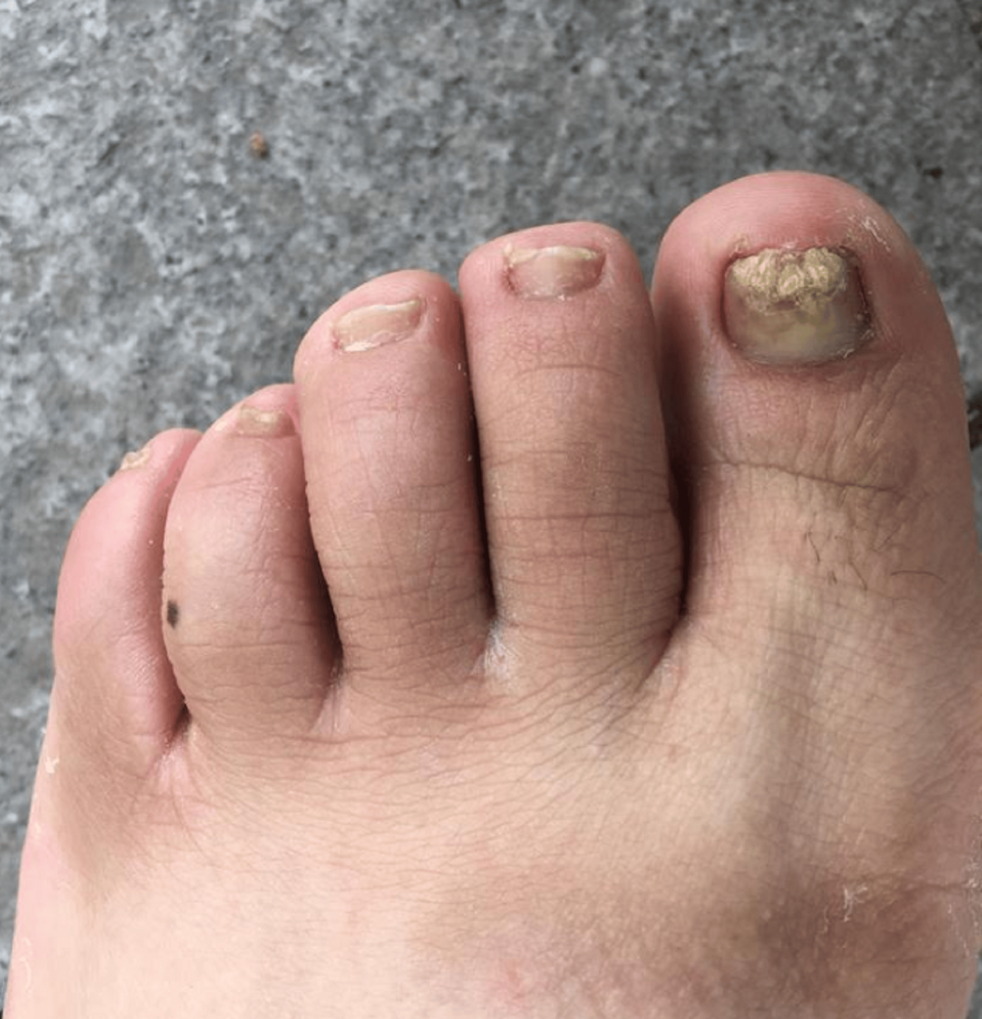 灰指甲如何根治不反复?过来人支上你几招,1个月坏甲自动脱落!