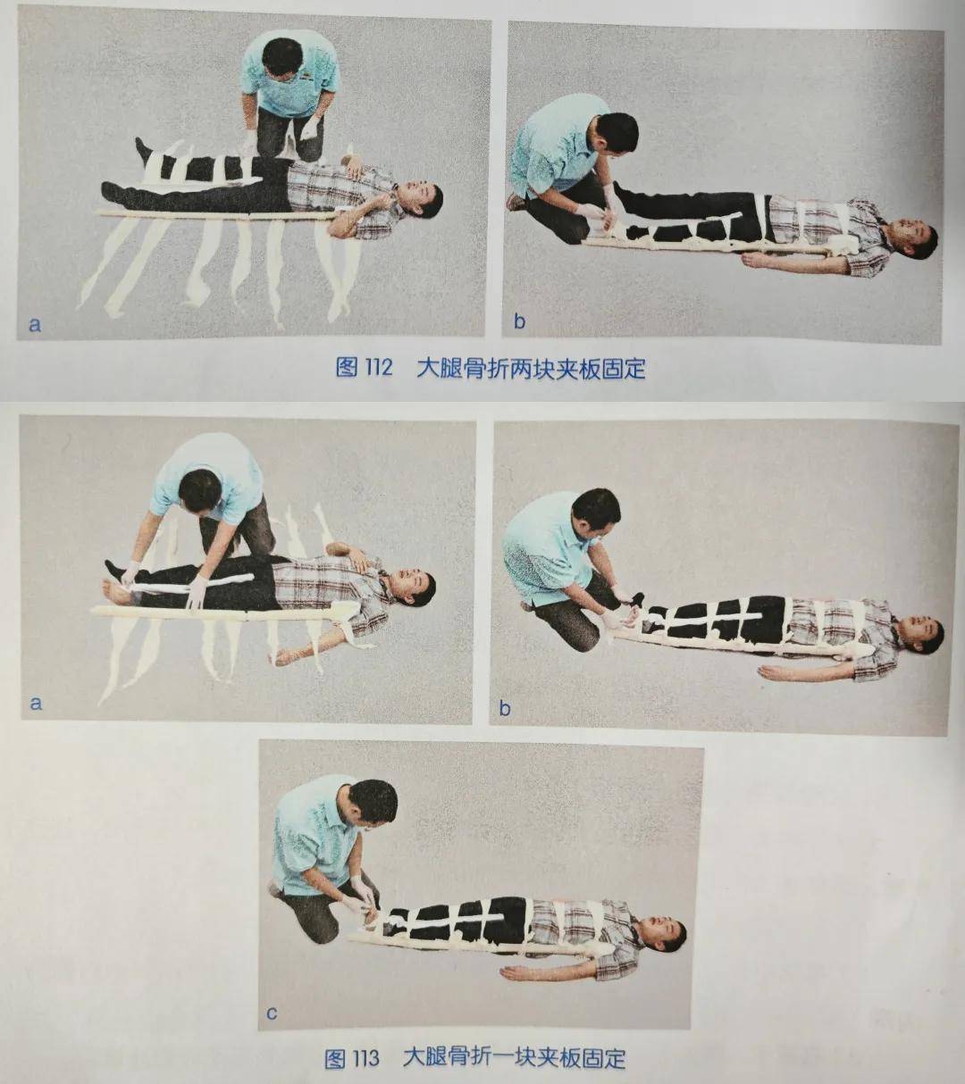 骨折固定有哪些方法